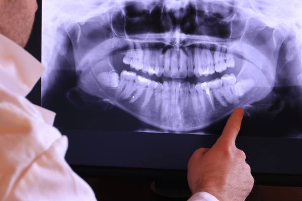 Best Emergency Tooth Extraction in Wellsville, KS